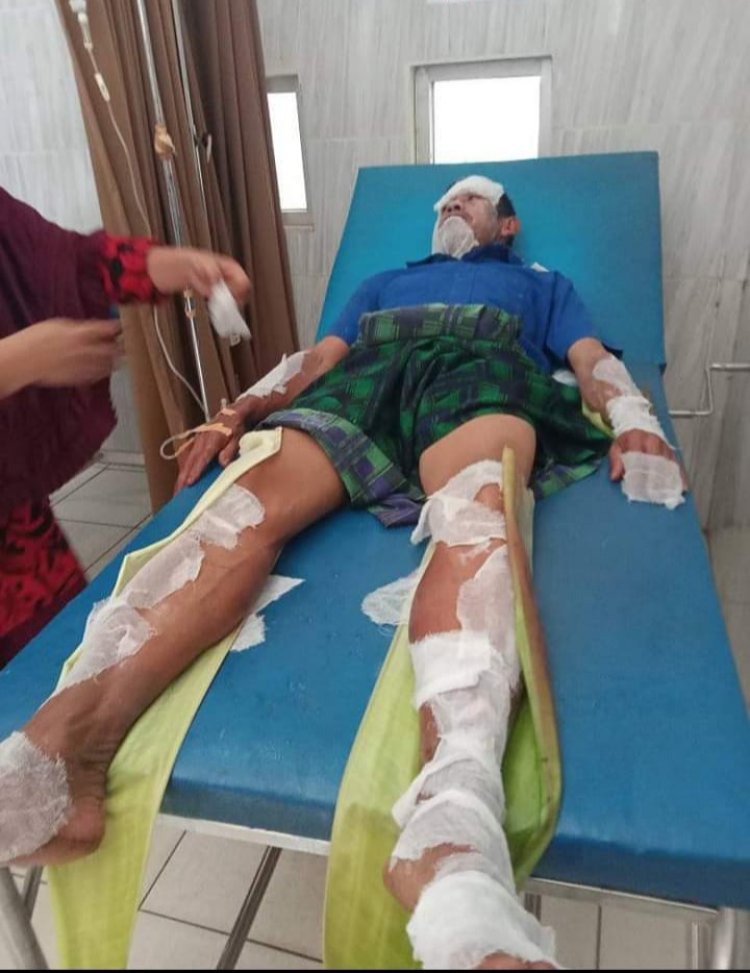 Saat Aqikahan, Seorang Warga Terbakar. Ini Penyebabnya